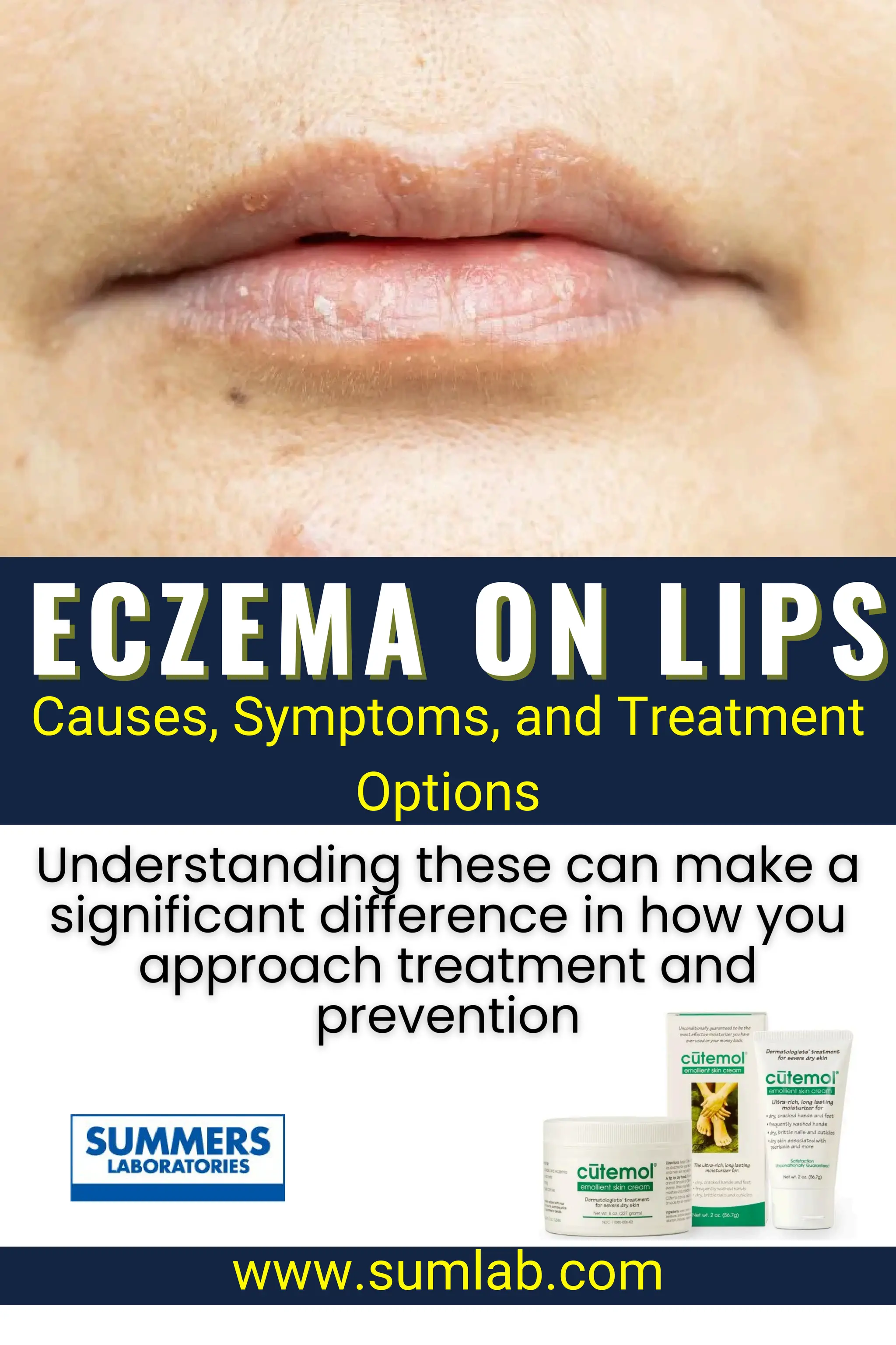 What vitamin deficiency causes eczema on lips? PDF