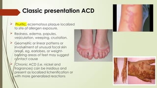 Localized Redeness ECZEMA ( dermatitis) part 1 dermatology slide in detail | PPTX