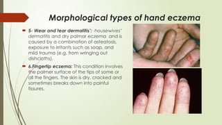 Hand Rash Differentials ECZEMA( dermatitis) PART 2.pptx in dermatology | PPTX