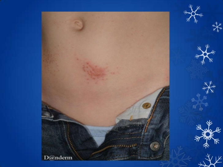 Aural eczematoid dermatitis - giliteden