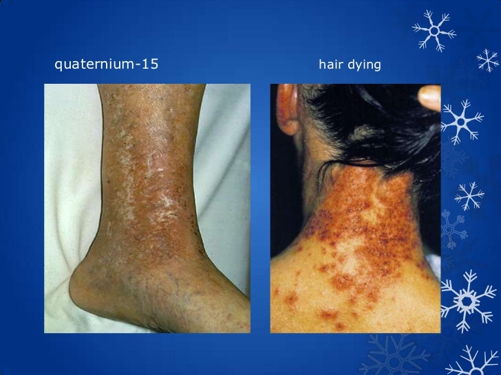 aural eczematoid dermatitis aural eczematoid dermatitis