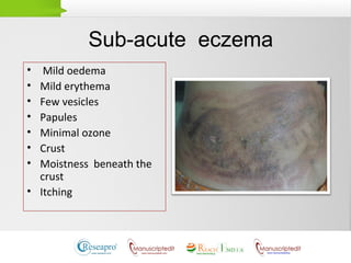 Sub-acute eczema
• Mild oedema
• Mild erythema
• Few vesicles
• Papules
• Minimal ozone
• Crust
• Moistness beneath the
crust
• Itching
 