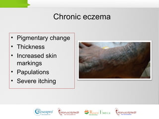 Chronic eczema
• Pigmentary change
• Thickness
• Increased skin
markings
• Papulations
• Severe itching
 
