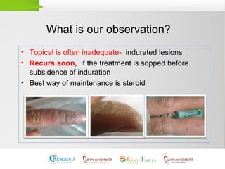 What is our observation?
• Topical is often inadequate- indurated lesions
• Recurs soon, if the treatment is sopped before
subsidence of induration
• Best way of maintenance is steroid
 