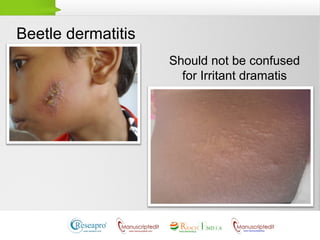 Beetle dermatitis
Should not be confused
for Irritant dramatis
 