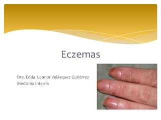 Eczemas
Dra. Edda Leonor Velásquez Gutiérrez
Medicina Interna
 