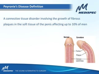 A connective tissue disorder involving the growth of fibrous
plaques in the soft tissue of the penis affecting up to 10% of men
Peyronie’s Disease Definition
 