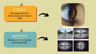 CORNEA:
AQUEOUS
FLUID:
Damage/infection
limits acuity and visual
field
Glaucoma limits acuity
and visual field
 