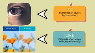 IRIS:
LENS:
Malformation causes
light sensitivity
Cataracts affect vision,
color, light sensitivity
 