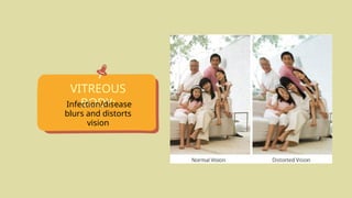 VITREOUS
BODY:
Infection/disease
blurs and distorts
vision
 