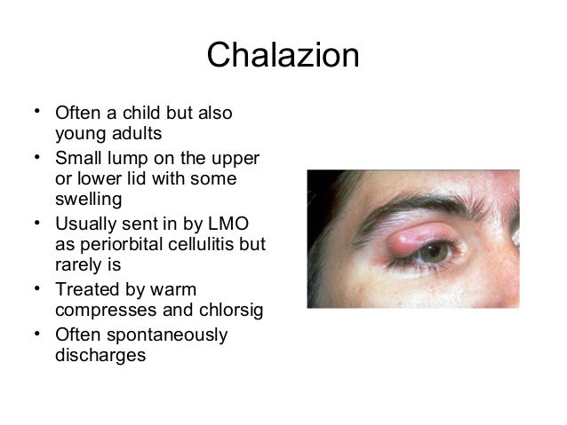 Opthalmology in the ED - Dr Andrew White (June 2013)