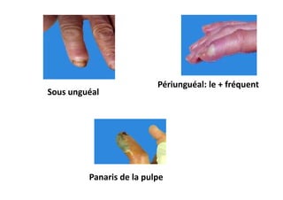 Périunguéal: le + fréquent
Sous unguéal




         Panaris de la pulpe
 