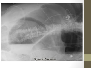 Sigmoid Volvulus
 