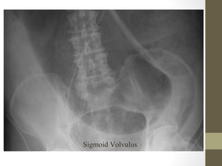 Sigmoid Volvulus
 