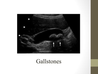Gallstones
 