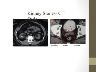 Kidney Stones- CT
Style
 