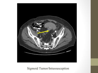 Sigmoid Tumor/Intussusception
 