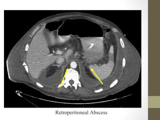 Retroperitoneal Abscess
 