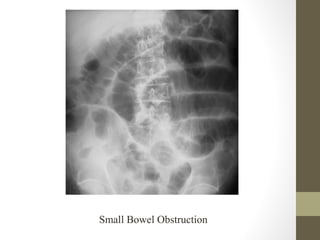 Small Bowel Obstruction
 
