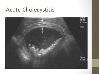 Acute Cholecystitis
 