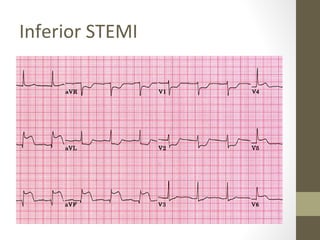 Inferior STEMI
 