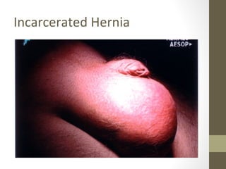 Incarcerated Hernia
 
