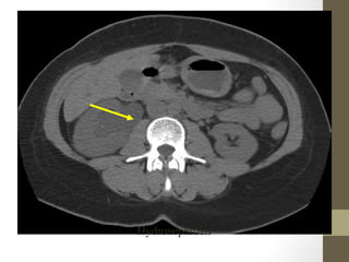 Hydronephrosis
 