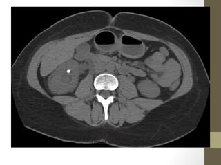 Renal Calculus
 