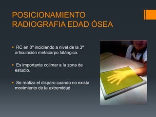 Edad ósea | PPTX
