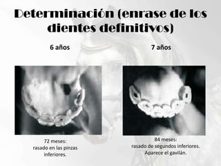 Determinación (enrase de los dientes definitivos)6 años7 años84 meses:rasado de segundos inferiores.Aparece el gavilán.72 meses:rasado en las pinzasinferiores.
