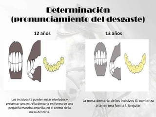 Determinación (pronunciamiento del desgaste)12 años13 añosLos incisivos I1 pueden estar nivelados y presentar una estrella dentaria en forma de una pequeña mancha amarilla, en el centro de la mesa dentaria.La mesa dentaria de los incisivos I1 comienza a tener una forma triangular