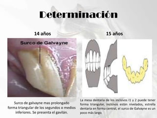 Determinación14 años15 añosLa mesa dentaria de los incisivos I1 y 2 puede tener forma triangular, incisivos están nivelados, estrella dentaria en forma central, el surco de Galvayne es un poco más largo.Surco de galvayne mas prolongadoforma triangular de los segundos o medios inferiores. Se presenta el gavilán.