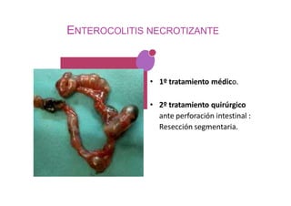 ENTEROCOLITIS NECROTIZANTE
• 1º tratamiento médico.
• 2º tratamiento quirúrgico
ante perforación intestinal :
Resección segmentaria.
 