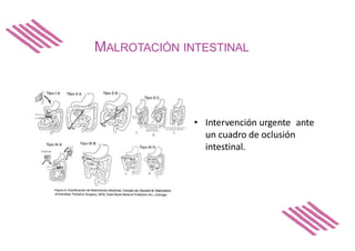 MALROTACIÓN INTESTINAL
• Intervención urgente ante
un cuadro de oclusión
intestinal.
 