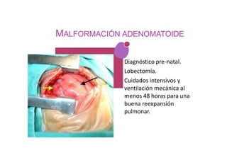 MALFORMACIÓN ADENOMATOIDE
• Diagnóstico pre-natal.
• Lobectomía.
• Cuidados intensivos y
ventilación mecánica al
menos 48 horas para una
buena reexpansión
pulmonar.
 