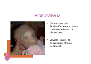 HIDROCEFALIA
• Neuroendoscopia:
Realización de unos nuevos
conductos salvando la
obstrucción.
• Válvulas (shunts) de
derivación ventriculo-
peritoneal.
 