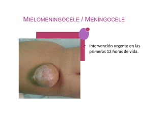 MIELOMENINGOCELE / MENINGOCELE
• Intervención urgente en las
primeras 12 horas de vida.
 