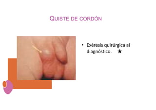 QUISTE DE CORDÓN
• Exéresis quirúrgica al
diagnóstico. ★
 
