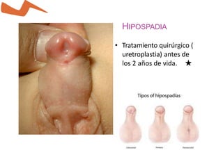 HIPOSPADIA
• Tratamiento quirúrgico (
uretroplastia) antes de
los 2 años de vida. ★
 