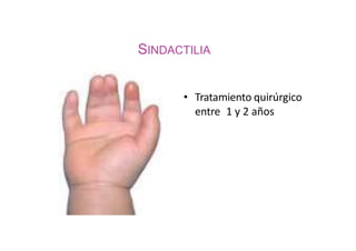 SINDACTILIA
• Tratamiento quirúrgico
entre 1 y 2 años
 