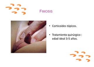 FIMOSIS
• Corticoides tópicos.
• Tratamiento quirúrgico :
edad ideal 3-5 años.
 