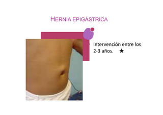 HERNIA EPIGÁSTRICA
• Intervención entre los
2-3 años. ★
 