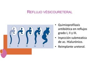 REFLUJO VÉSICOURETERAL
• Quimioprofilaxis
antibiótica en reflujos
grado I, II y III.
• Inyección submeatica
de ac. Hialurónico.
• Reimplante ureteral.
 
