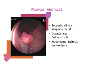 PÓLIPOS RECTALES
• Sospecha clínica:
sangrado rectal
• Diagnóstico:
Colonoscopia .
• Tratamiento: Exéresis
endoscópica.
 