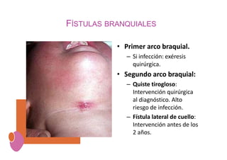 FÍSTULAS BRANQUIALES
• Primer arco braquial.
– Si infección: exéresis
quirúrgica.
• Segundo arco braquial:
– Quiste tirogloso:
Intervención quirúrgica
al diagnóstico. Alto
riesgo de infección.
– Fístula lateral de cuello:
Intervención antes de los
2 años.
 