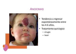 ANGIOMAS
• Tendencia a regresar
espontáneamente entre
los 4-6 años.
• Tratamiento quirúrgico
– cirugía
– laser
 