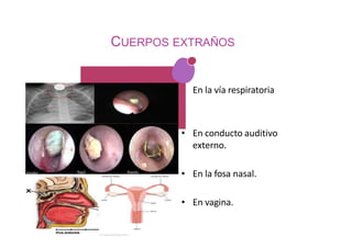 CUERPOS EXTRAÑOS
• En la vía respiratoria
• En conducto auditivo
externo.
• En la fosa nasal.
• En vagina.
 