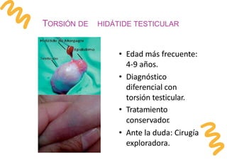 TORSIÓN DE HIDÁTIDE TESTICULAR
• Edad más frecuente:
4-9 años.
• Diagnóstico
diferencial con
torsión testicular.
• Tratamiento
conservador
.
• Ante la duda: Cirugía
exploradora.
 