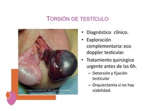 TORSIÓN DE TESTÍCULO
• Diagnóstico clínico.
• Exploración
complementaria: eco
doppler testicular.
• Tratamiento quirúrgico
urgente antes de las 6h.
– Detorsión y fijación
testicular
– Orquiectomia si no hay
viabilidad.
 