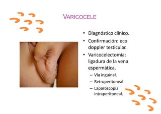VARICOCELE
• Diagnóstico clínico.
• Confirmación: eco
doppler testicular.
• Varicocelectomia:
ligadura de la vena
espermática.
– Vía inguinal.
– Retroperitoneal
– Laparoscopia
intraperitoneal.
 